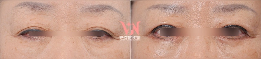 Honest Advice from a Plastic Surgeon on Finding a Good Clinic for Middle-Aged Eye Surgery image 10