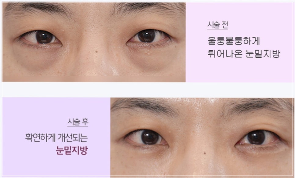 눈밑지방재배치 시술 효과, 통증, 붓기, 후 관리까지 이 글로 종결 관련 이미지 3