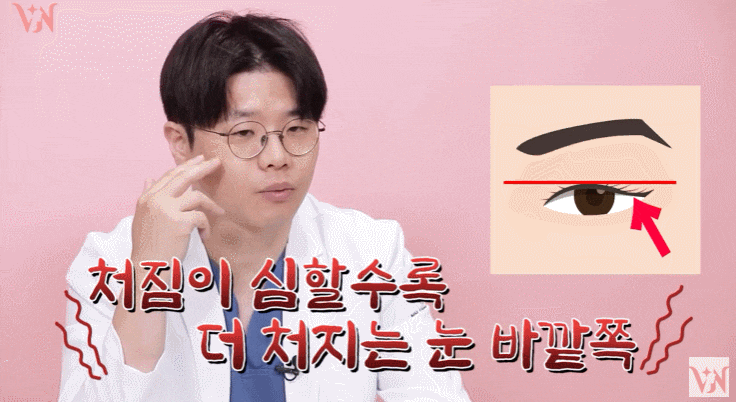 A Case Where Upper Blepharoplasty in Gangnam Won’t Help, a Plastic Surgeon’s Honest Opinion image 13