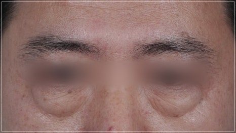 Conditions for Under-Eye Fat Repositioning in Gangnam That Lasts Long, Is Safe, and Allows a Quick Return to Daily Life image 6