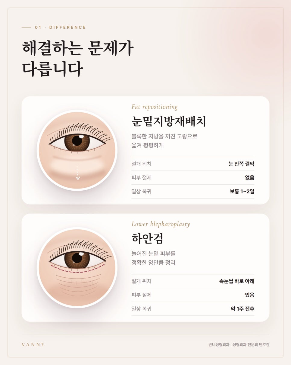 눈밑지방재배치 하안검 차이, 상담실에서 보는 눈밑 유형 3가지 관련 이미지 2