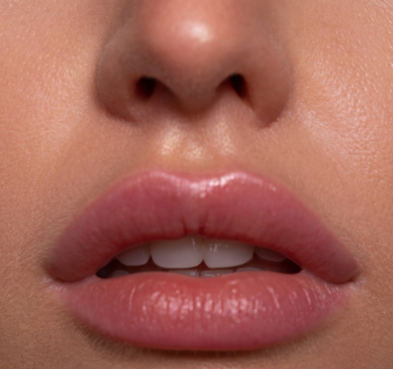 Causes and Prevention of Lip Filler Side Effects Such as Visibility, Lumps, and Asymmetry: A Dermatology Director’s Candid Advice image 8