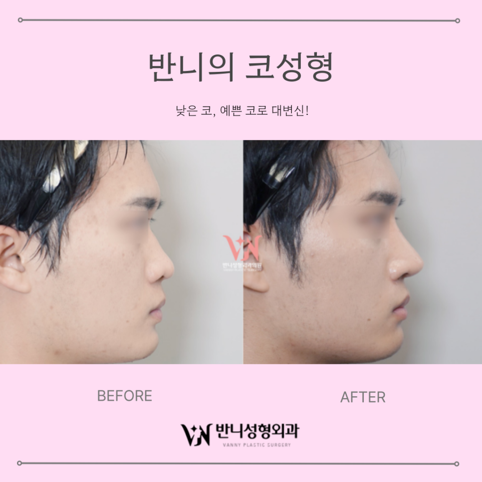 Gangnam Rhinoplasty: The Process of Finding Natural Proportions and Harmony image 3