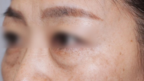 Eye Bag Repositioning Surgery Cost: A Plastic Surgeon Explains How to Find an Affordable, Good Clinic image 15