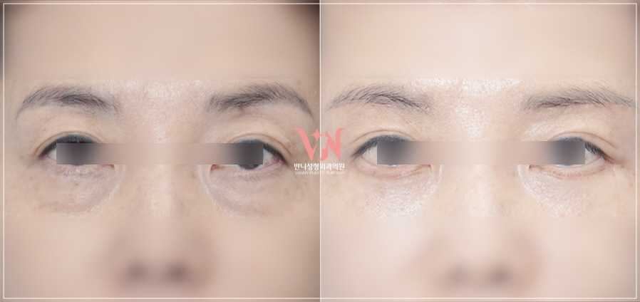 강남 눈밑지방재배치 재발없이가격까지 착한 병원 고르는 법 관련 이미지 21
