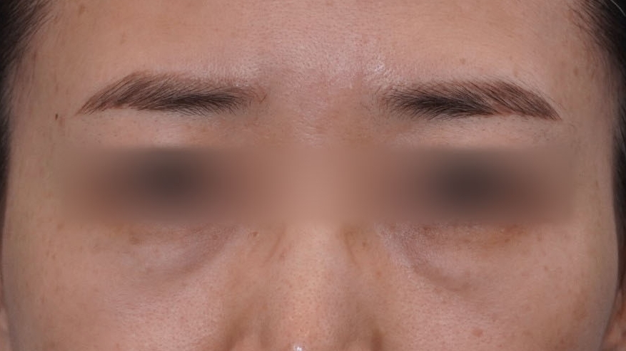 Under-Eye Fat Repositioning Recovery Period: Just Two Days! A Plastic Surgeon Reveals the Conditions for a Quick Return to Daily Life image 14