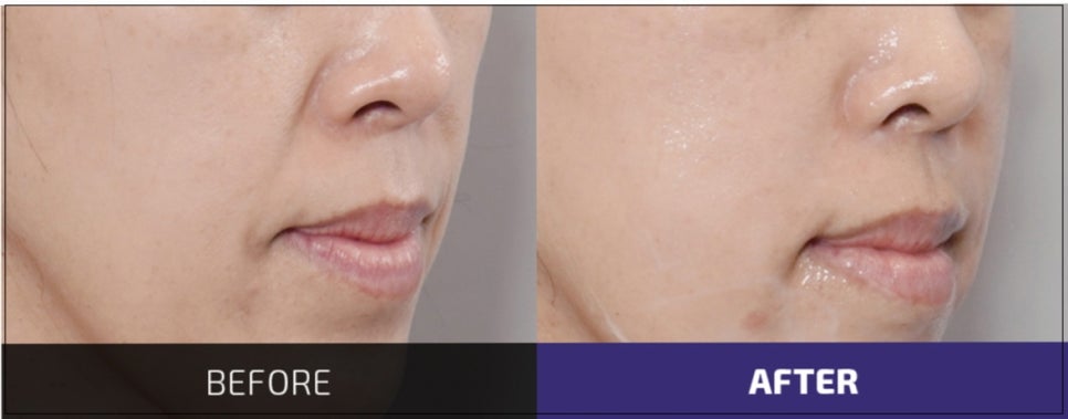 The Best Place for Thread Lifting for Nasolabial Folds in Gangnam Improves Both Hollowness and Sagging. image 4