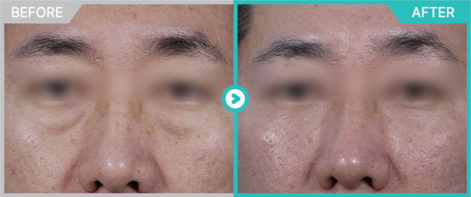 A Doctor with 20,000 Clinical Cases Shares How to Find the Best Under-Eye Filler Clinic in Gangnam image 4