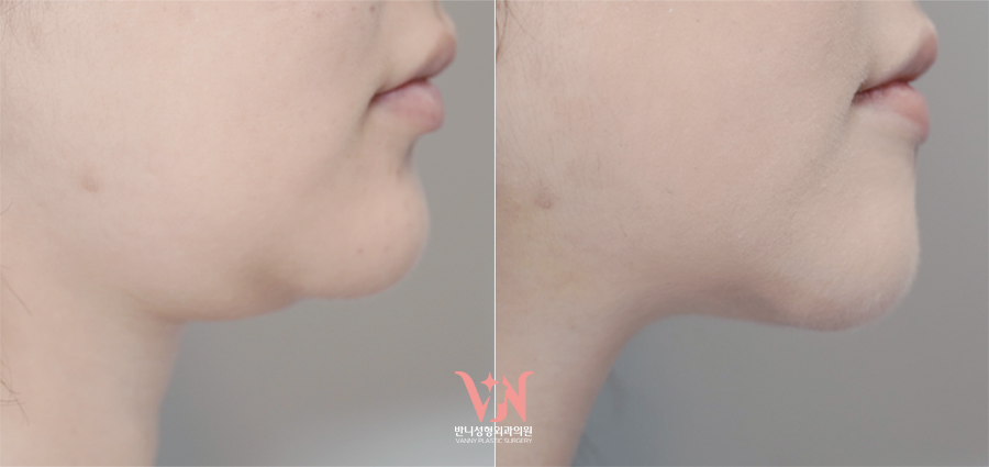 If your face is like this, "buccal fat removal" is not the first step — Gangnam "buccal fat lifting" is. image 22