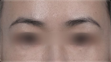 강남 눈밑지방재배치 재발없이가격까지 착한 병원 고르는 법 관련 이미지 27
