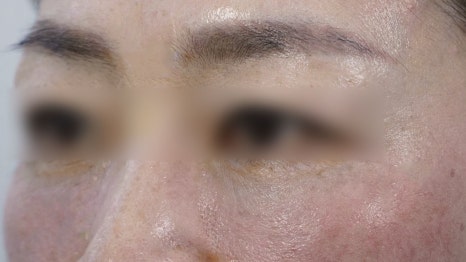Eye Bag Repositioning Surgery Cost: A Plastic Surgeon Explains How to Find an Affordable, Good Clinic image 16
