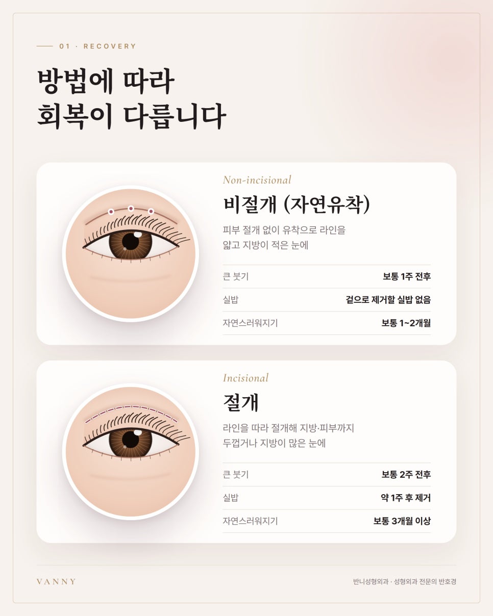 수능 끝나고 쌍꺼풀, 수험생·부모님이 상담실에서 가장 많이 묻는 4가지 관련 이미지 2