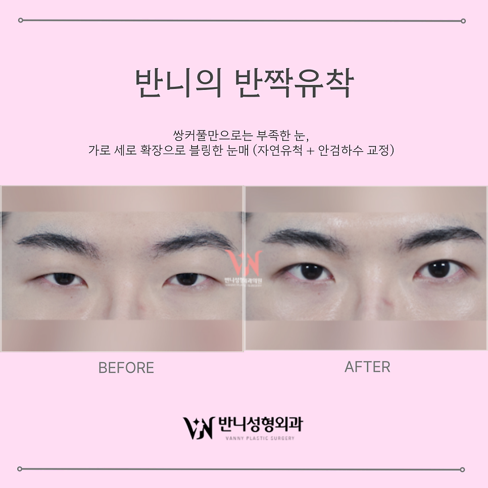Men’s Double Eyelids: Why They Must Be Different from Women’s, Check Now. image 5