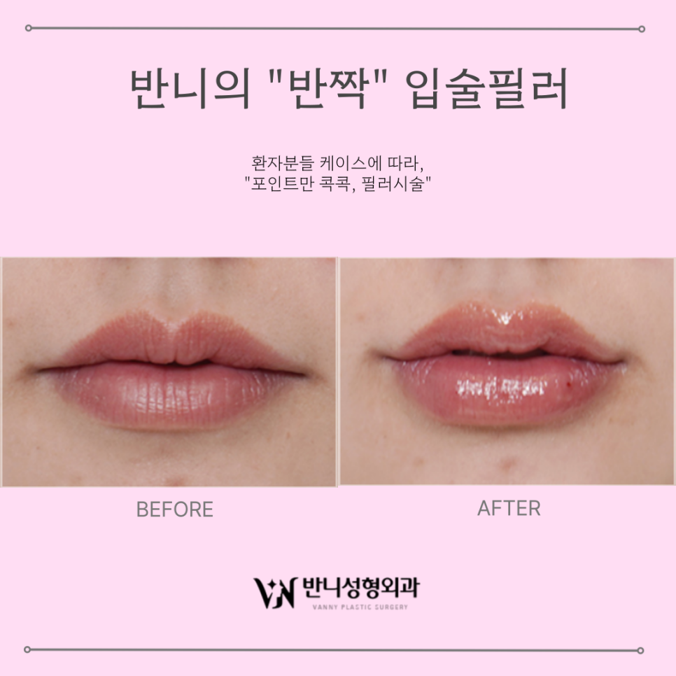 Lip Filler Before and After: A Choice for Natural, Attractive Lips image 4