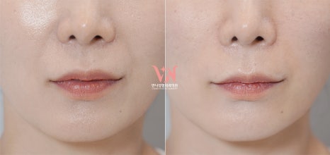If your face is like this, "buccal fat removal" is not the first step — Gangnam "buccal fat lifting" is. image 33
