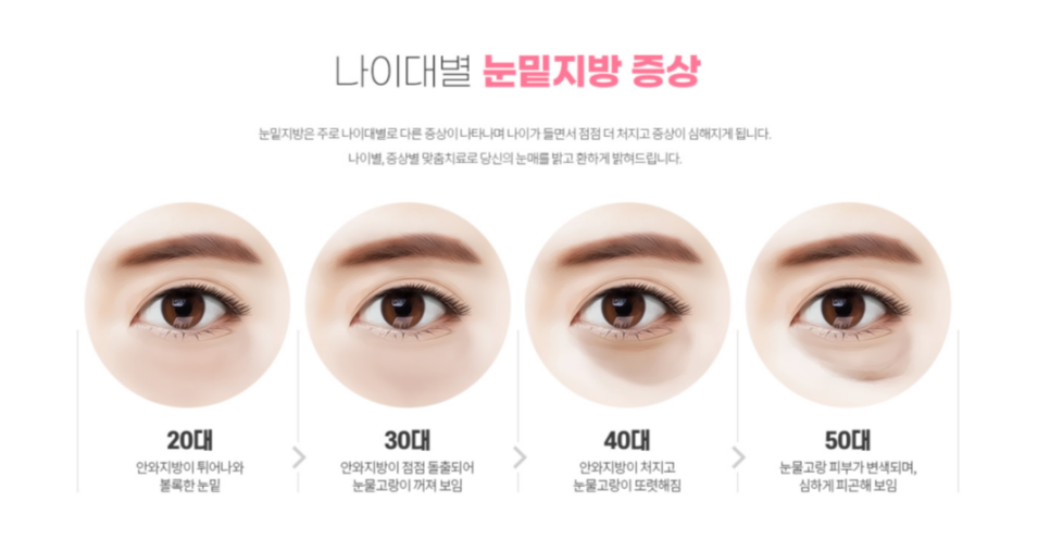 Under-Eye Fat Laser Treatment: Brightening the Eye Area Without the Burden image 1