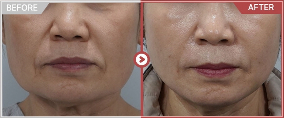 Thermage Effect Timing, Duration, and Treatment Interval: A Dermatology Director in Gangnam Shares an Honest View image 4