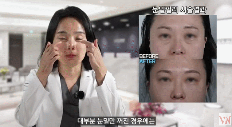 눈밑꺼짐필러 부작용 진실, 실제 효과는? 피부과 의사의 팩트체크 관련 이미지 3