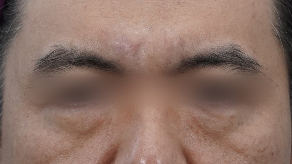 Under-Eye Fat Repositioning Recovery Period: Just Two Days! A Plastic Surgeon Reveals the Conditions for a Quick Return to Daily Life image 9
