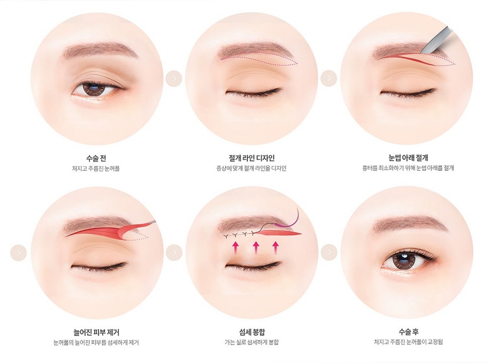 A Case Where Upper Blepharoplasty in Gangnam Won’t Help, a Plastic Surgeon’s Honest Opinion image 12