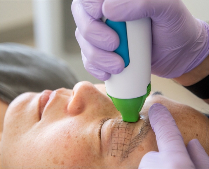 Eye Thermage and Eye Ulthera: Treatment Areas and Effects, a Dermatology Director's Honest Opinion image 12