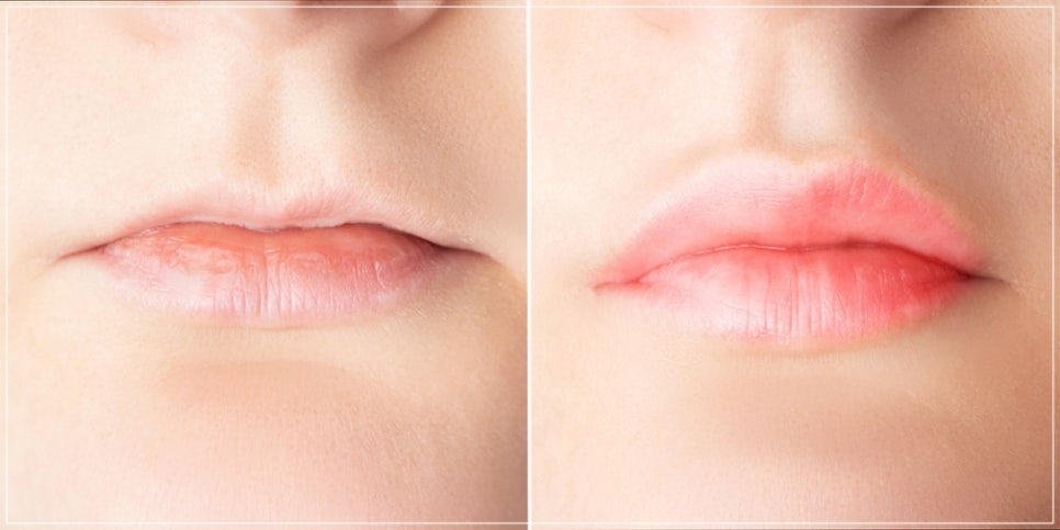 Causes and Prevention of Lip Filler Side Effects Such as Visibility, Lumps, and Asymmetry: A Dermatology Director’s Candid Advice image 6