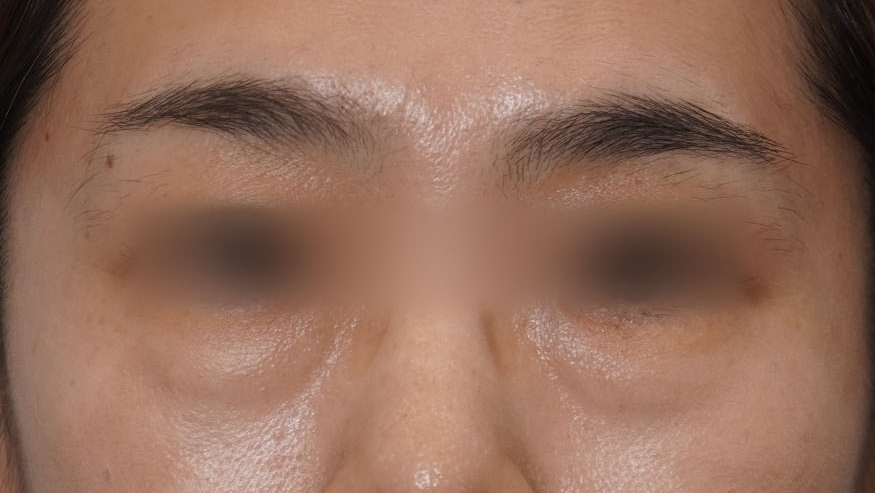 Eye Bag Repositioning Surgery Cost: A Plastic Surgeon Explains How to Find an Affordable, Good Clinic image 2