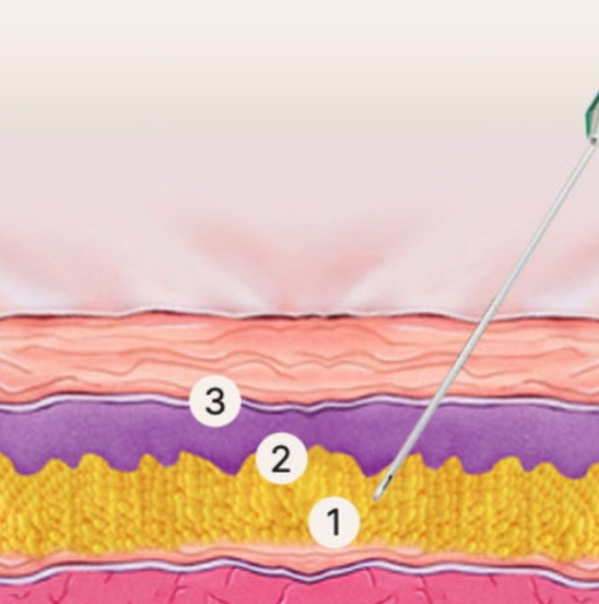 A Doctor with 20,000 Clinical Cases Shares How to Find the Best Under-Eye Filler Clinic in Gangnam image 12