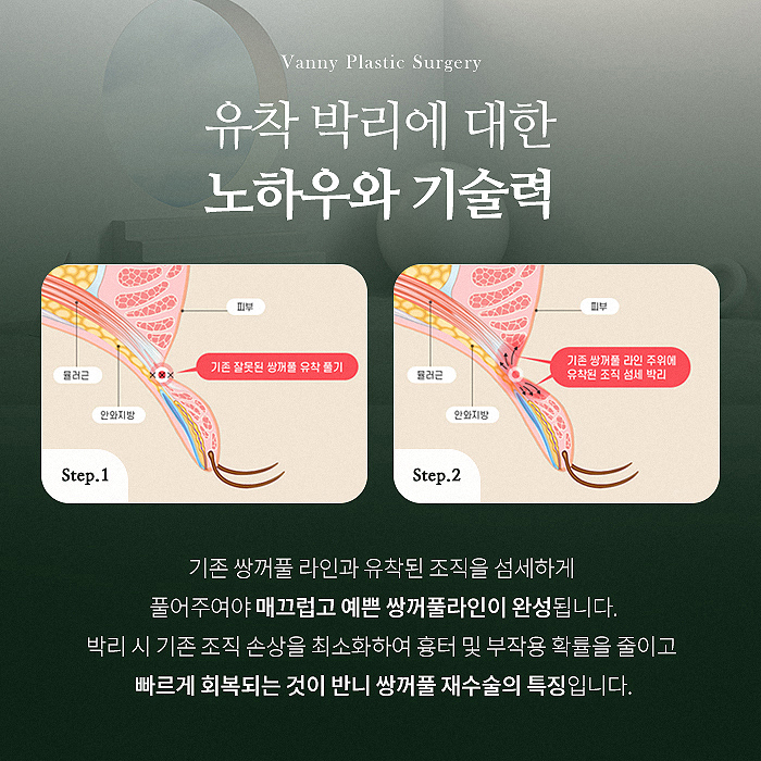 강남눈성형잘하는곳 다시 알아보게 된다면 관련 이미지 5