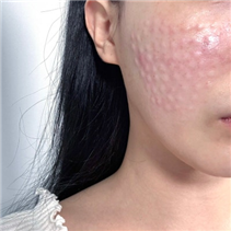 Gangnam Re2O Treatment: Controversy Over Use of Human Tissue and Side Effects? Misconceptions and Facts About Re2O. image 25