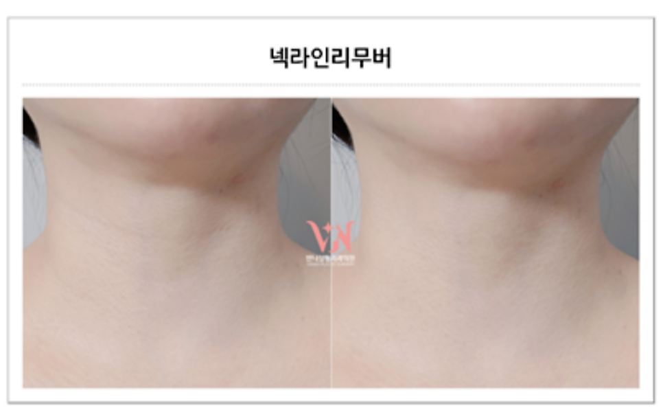 목주름시술 후기 병원 선택이 중요한 이유 관련 이미지 3