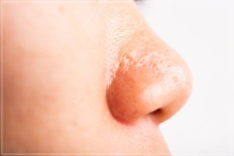 How to Reduce Pores in Gangnam: The Real Effect of Potenza Pumping Tip for Nose Pores, Explained by a Dermatology Clinic Director image 8