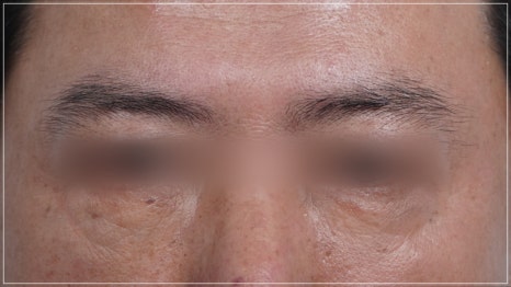 Conditions for Under-Eye Fat Repositioning in Gangnam That Lasts Long, Is Safe, and Allows a Quick Return to Daily Life image 7