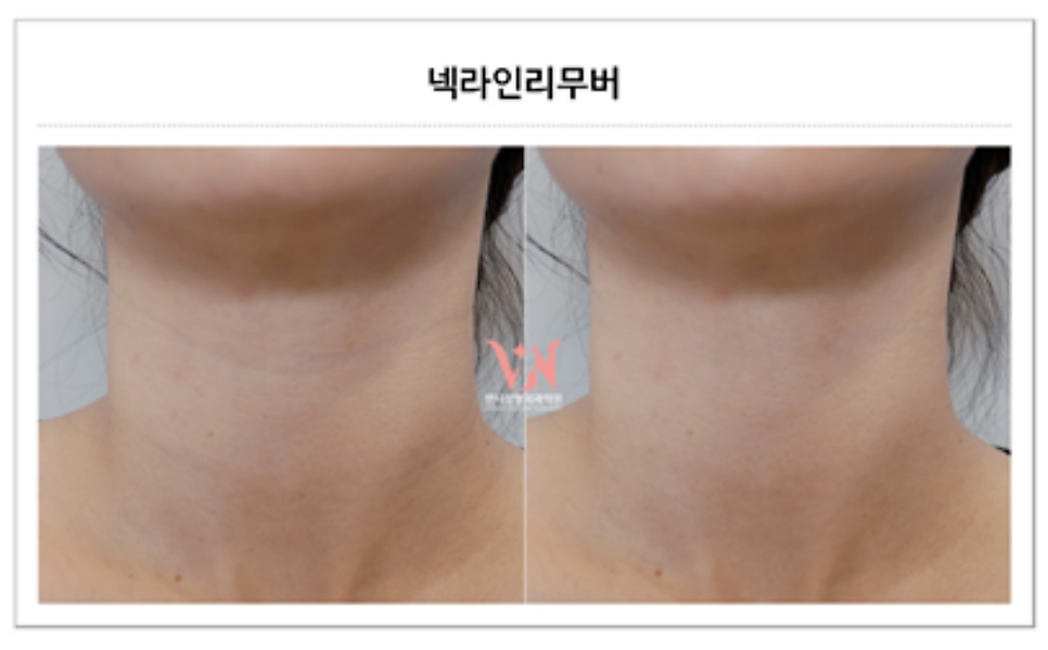 목주름시술 후기 병원 선택이 중요한 이유 관련 이미지 2