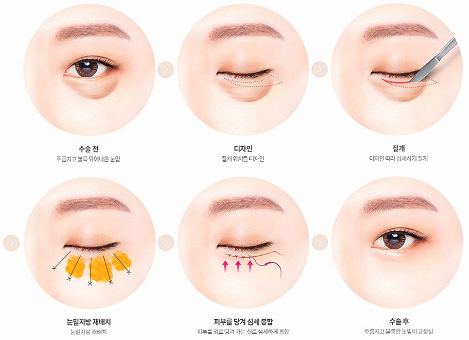 눈밑지방재배치 다크서클 해결 가능? 성형외과 전문의의 솔직 의견 관련 이미지 12