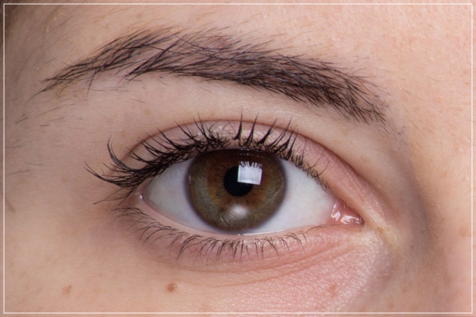Eye Thermage and Eye Ulthera: Treatment Areas and Effects, a Dermatology Director's Honest Opinion image 6