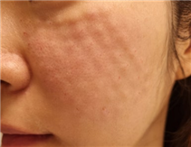 Gangnam Re2O Treatment: Controversy Over Use of Human Tissue and Side Effects? Misconceptions and Facts About Re2O. image 27