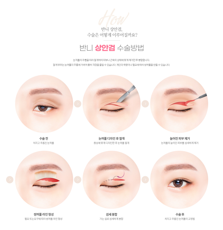 상안검수술 눈처짐이 고민이라면 관련 이미지 4
