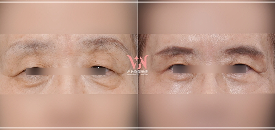 강남 하안검수술 잘하는 병원 가릴 수 있는 3가지 질문(부작용) 관련 이미지 13
