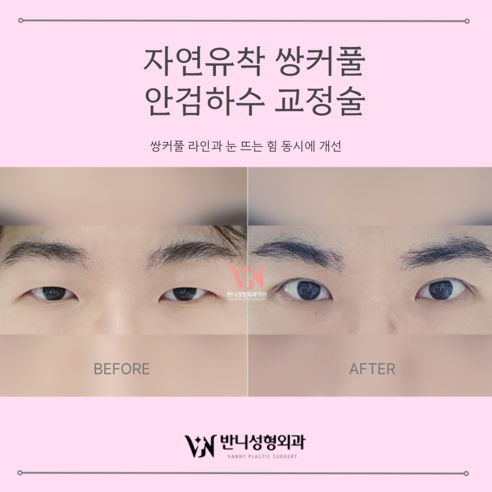 Key Points That Reveal the Difference Before and After Male Eye Correction image 6