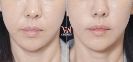 If your face is like this, "buccal fat removal" is not the first step — Gangnam "buccal fat lifting" is. image 39