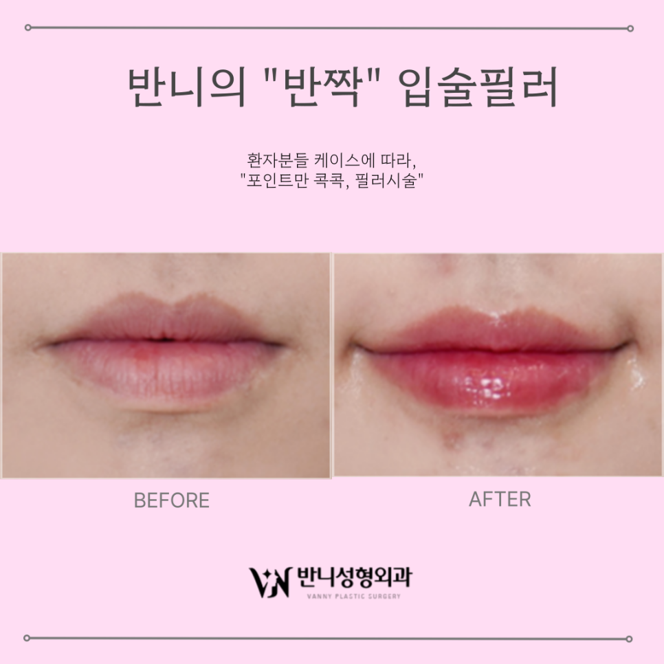 Lip Filler Before and After: A Choice for Natural, Attractive Lips image 2