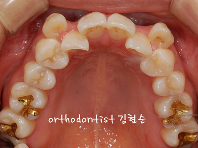 강남 덧니 관련 이미지 7