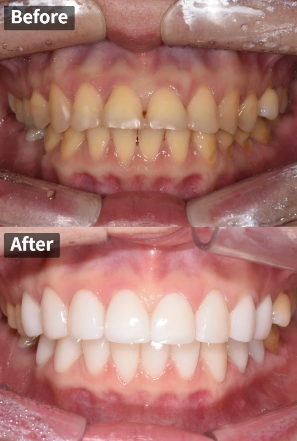 학동역 라미네이트 전후, 치아 모양과 색상 개선 사례 관련 이미지 1