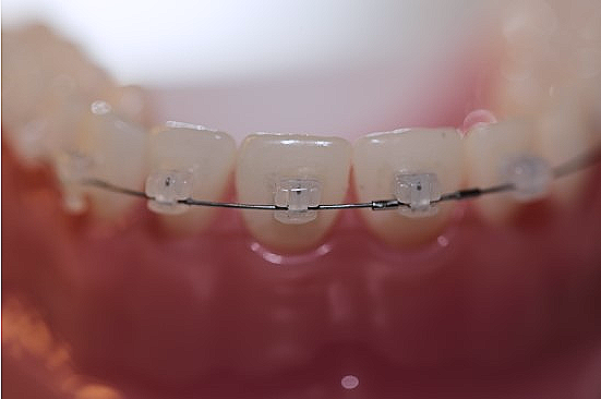 강남 세라믹 교정 관련 이미지 4