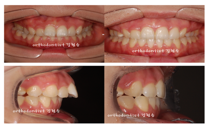 강남 돌출입 관련 이미지 9
