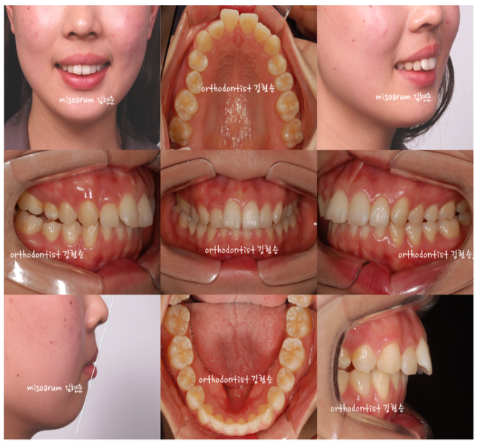 강남 돌출입 관련 이미지 5
