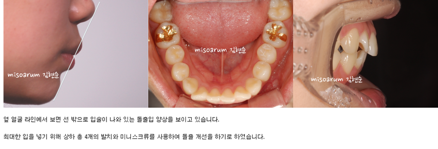 세라믹교정 세라믹치과-돌출입발치교정 9 관련 이미지 2