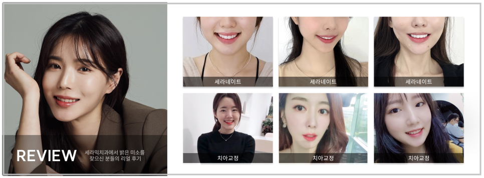 20대 돌출입교정, 무턱교정, 치아교정전후 세련된 얼굴 라인을 되찾다! 관련 이미지 12