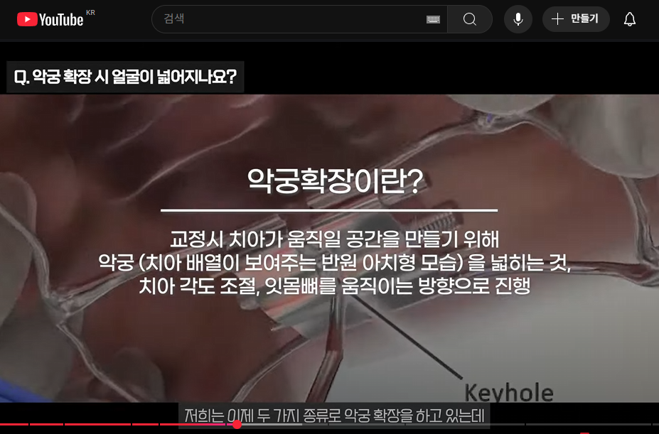 강남치아교정, 악궁확장하면 얼굴크기 커질까? 관련 이미지 2